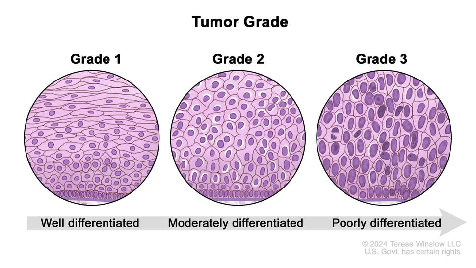 Three-panel drawing showing different grades of breast cancer cells based on how abnormal they look under a microscope. The first panel shows grade 1 or well-differentiated cancer cells. The second panel shows grade 2 or moderately differentiated cancer cells. The third panel shows grade 3 or poorly differentiated cancer cells.
