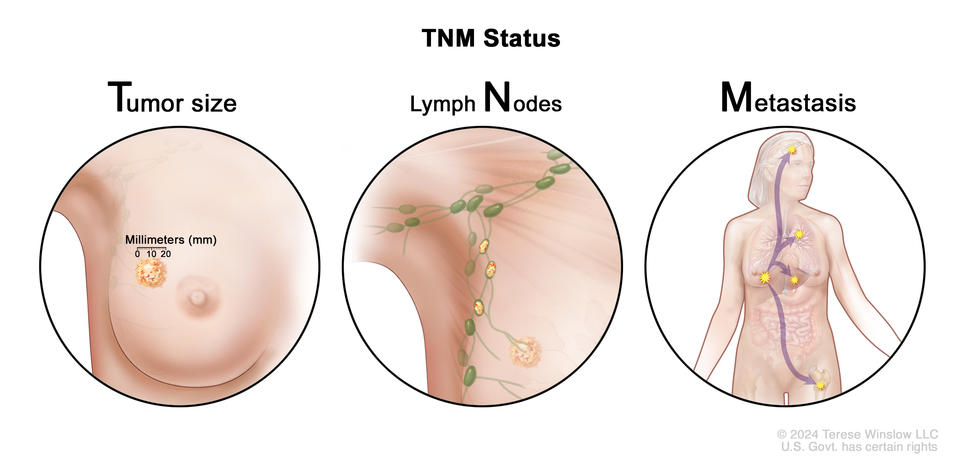Three-panel drawing showing the TNM (tumor node metastasis) staging system for breast cancer. The first panel shows a tumor in the breast that measures 20 millimeters with a ruler. The second panel shows cancer that has spread from the breast to three nearby lymph nodes. The third panel shows cancer that has spread from the breast to other parts of the body, including the brain, lung, liver, and bone.