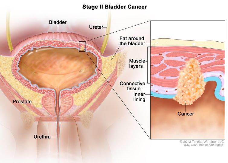 Drawing of stage II bladder cancer, also known as muscle-invasive bladder cancer. An inset shows cancer in the inner lining of the bladder and in the layer of connective tissue and the muscle layers of the bladder. 