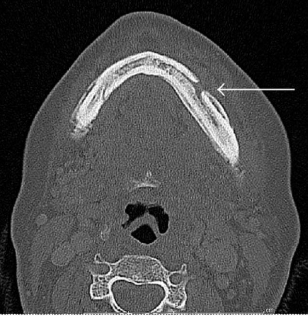 Una tomografía computarizada de una mandíbula con una flecha señalando un área abierta en el hueso.
