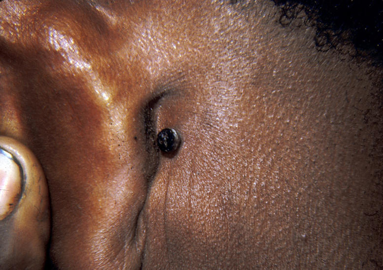 A black man holds his ear forward to show a basal cell skin cancer tucked into the fold at the back of his ear.