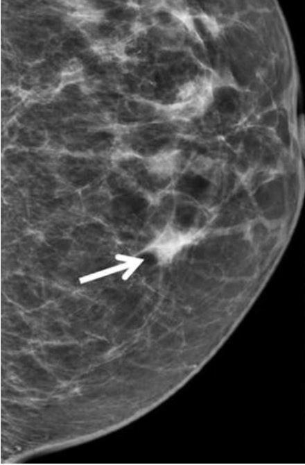 A mammogram showing a focal asymmetry in the breast.