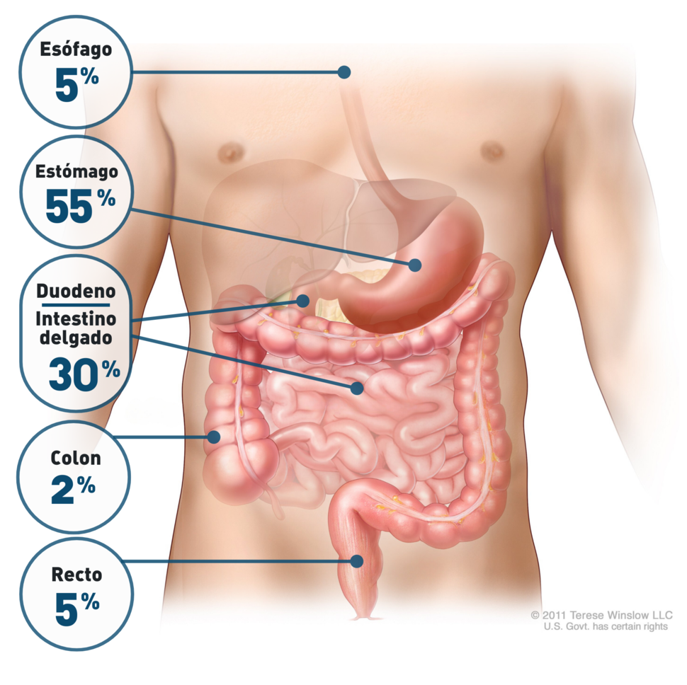 Imagen anatómica que indica la frecuencia con que se encuentran los tumores de estroma gastrointestinal (TEGI) en el aparato digestivo.