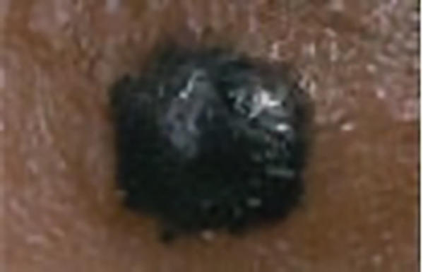 A melanoma skin cancer bump, appearing black in color, with a waxy, shiny surface.