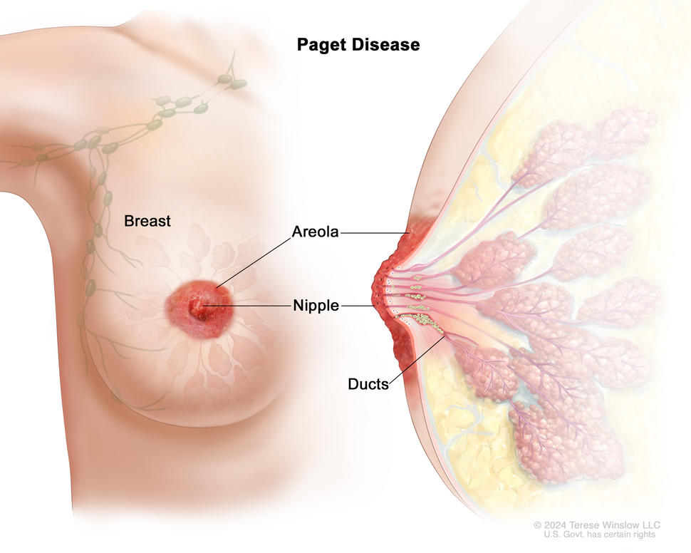 Illustration of Paget disease of the breast. Drawing shows a front view of the breast with redness and crusting of the nipple and areola. Also shown is a cross section of the breast with cancer cells in the breast ducts.