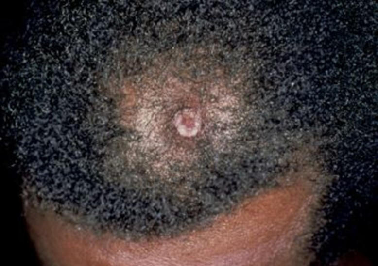 The top of a black man's head shows a squamous cell carcinoma lesion.