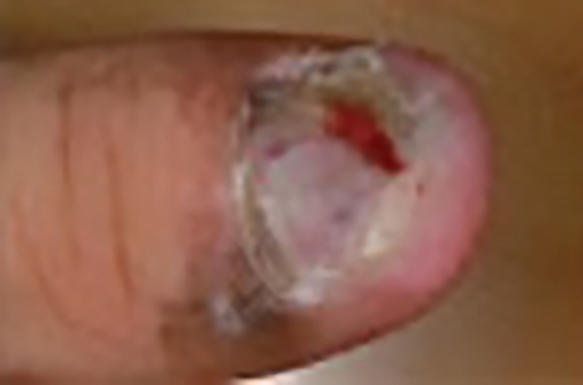 Acral lentiginous melanoma appearing as a dark band under a toe nail.