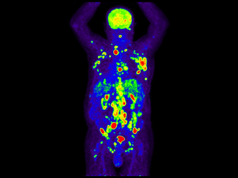 An FDG-PET scan of a man with Hodgkin lymphoma showing cancer (marked by areas of red and yellow-orange) throughout the upper body.