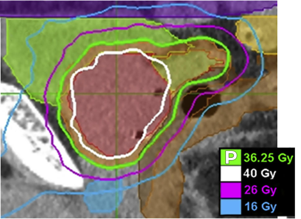 An imaging scan of the prostate and surrounding area depicting an SBRT treatment plan.