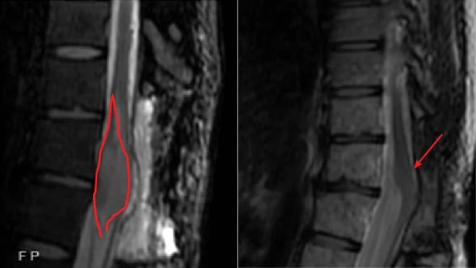 A before and after imaging scans showing a near complete response of a tumor in the spinal cord.