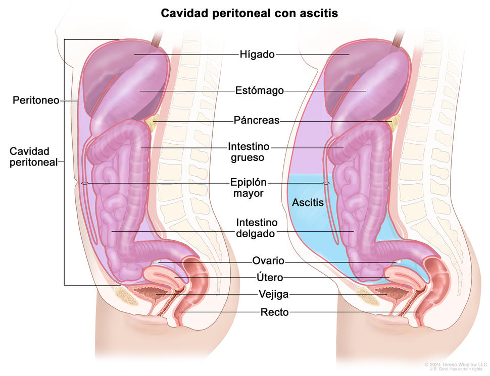 En el dibujo se observan dos cortes transversales de la cavidad peritoneal. En el corte transversal de la izquierda se observa una cavidad peritoneal normal. En el de la derecha, se observa una cavidad peritoneal con ascitis. Además, en ambos paneles se muestran el peritoneo, el hígado, el estómago, el páncreas, el intestino grueso, el epiplón mayor, el intestino delgado, un ovario, el útero, la vejiga y el recto.