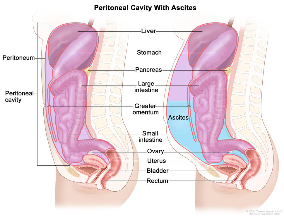 Illustration showing two cross-sections of the peritoneal cavity. On the left, a cross-section shows a normal peritoneal cavity. On the right, a cross-section shows a peritoneal cavity with ascites. Also shown in both panels are the peritoneum, liver, stomach, pancreas, large intestine, greater omentum, small intestine, ovary, uterus, bladder, and rectum.