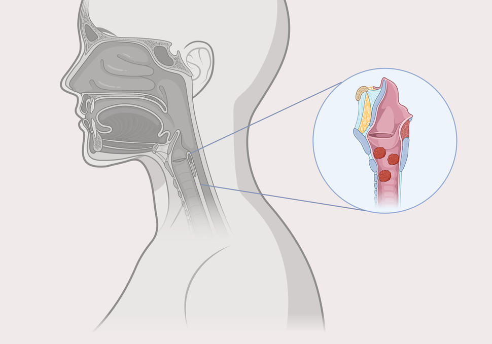 An illustration showing multiple benign tumors in the respiratory tract, characteristic of recurrent respiratory papillomatosis. 