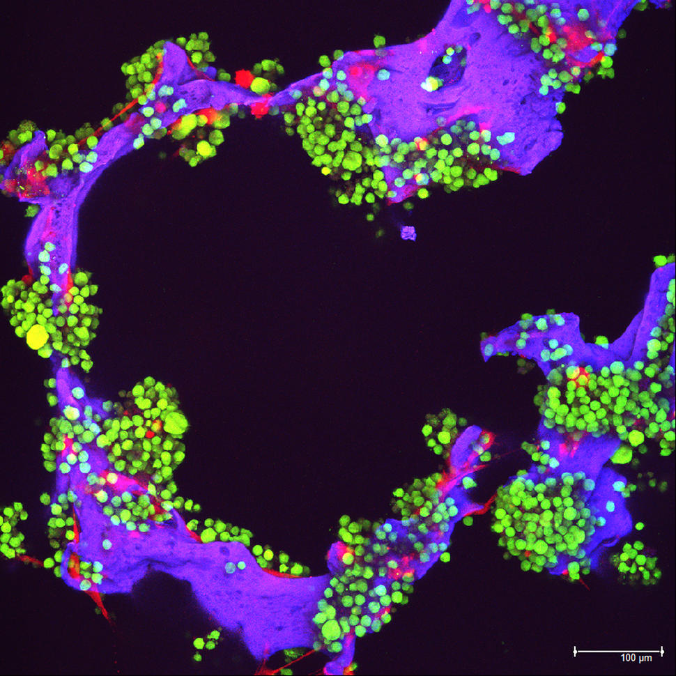  Myeloma tumor cells shown in green and bone cells shown in red, growing on a scaffold made of silk protein in purple, which is designed to resemble bone material.