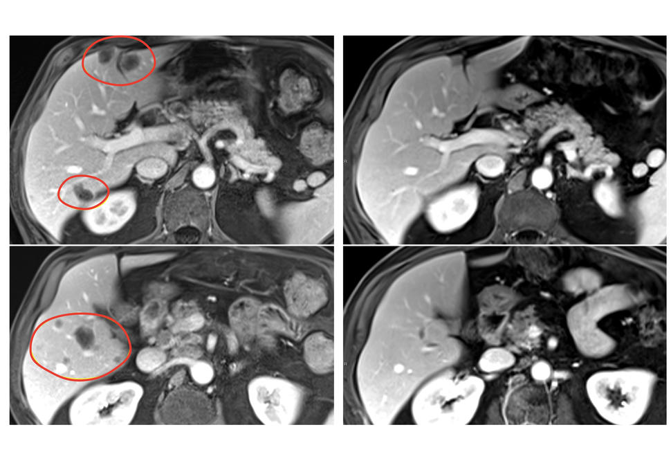 Four scans show before and after images of liver metastases shrinking after treatment with selected TIL therapy and pembrolizumab.