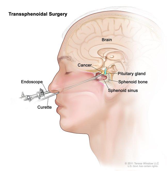Drawing shows an endoscope and a curette inserted through the nose and sphenoid sinus to remove cancer from the pituitary gland. The sphenoid bone is also shown.