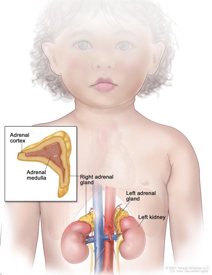 Drawing of the abdomen showing the left and right adrenal glands, the left and right kidneys, and major blood vessels. Also shown is an inset of an adrenal gland showing the adrenal cortex and the adrenal medulla.