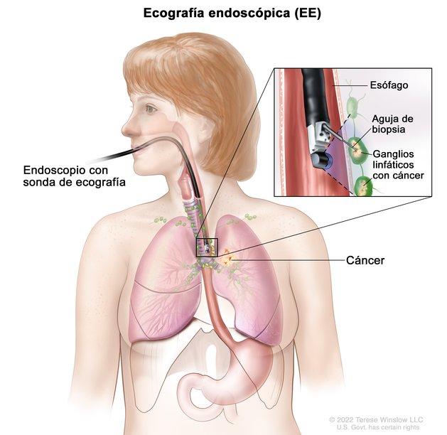 En la imagen se muestra un endoscopio con una sonda de ecografía y una aguja de biopsia que se introduce por la boca hasta el esófago. También se observan los ganglios linfáticos cerca del esófago y cáncer en un pulmón. En un recuadro se muestra la identificación de los ganglios linfáticos con cáncer mediante la sonda ecográfica y la extracción de tejido de uno de los ganglios linfáticos cercanos al esófago con la aguja de biopsia.