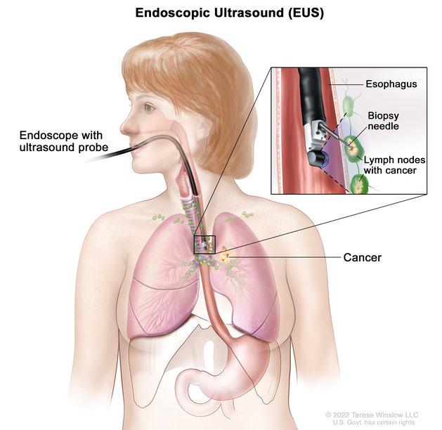Drawing shows an endoscope with an ultrasound probe and biopsy needle inserted through the mouth and into the esophagus. Also shown are the lymph nodes near the esophagus and cancer in one lung. An inset shows the ultrasound probe locating the lymph nodes with cancer and the biopsy needle removing tissue from one of the lymph nodes near the esophagus.