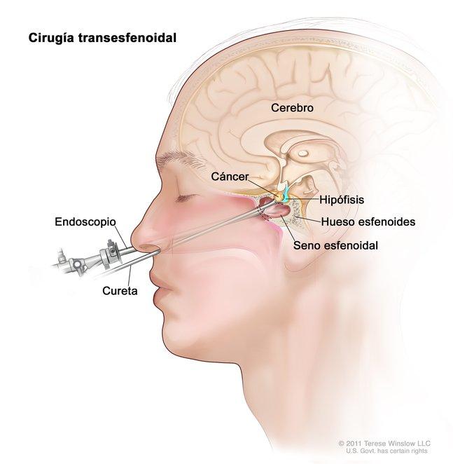 En la imagen se observan un endoscopio y una cureta introducidos a través de la nariz y el seno esfenoidal para extirpar un cáncer de la hipófisis. También se muestra el hueso esfenoides.
