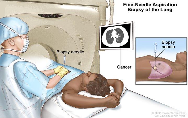 Drawing shows a patient lying on a table that slides through the computed tomography (CT) machine with an x-ray picture of a cross-section of the lung on a monitor above the patient. Drawing also shows a doctor using the x-ray picture to help place the biopsy needle through the chest wall and into the area of abnormal lung tissue. Inset shows a side view of the chest cavity and lungs with the biopsy needle inserted into the area of abnormal tissue.