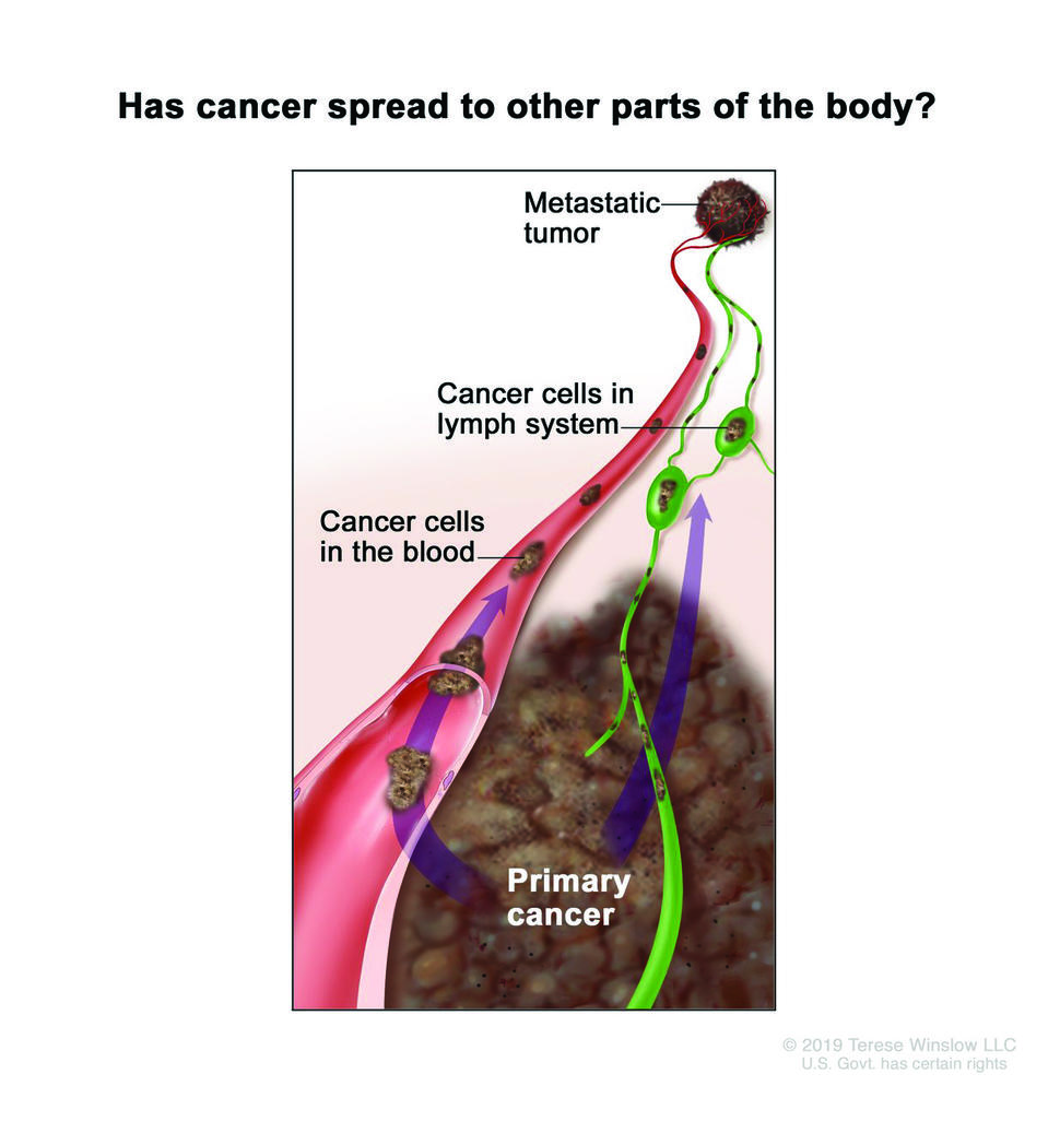 Illustration showing the spread of cancer from a tumor to other parts of the body, with labels showing cancer cells in the lymph system as well as cancer cells in a blood vessel. In the bottom part of the image, there is a large mass labeled "Primary cancer." Arrows indicate the movement of cancer cells from the primary site to the blood and lymphatic systems.