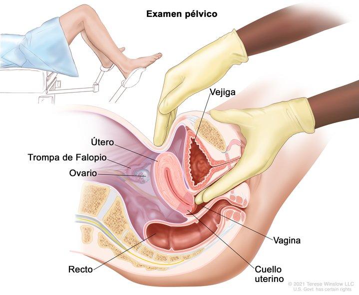 En la imagen se muestra una vista lateral anatómica del aparato reproductor femenino durante un examen pélvico. Se observan el útero, la trompa de Falopio izquierda, el ovario izquierdo, el cuello uterino, la vagina, la vejiga y el recto.
