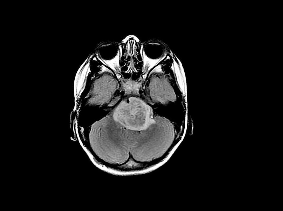 Axial brain MRI showing a large brain tumor in the posterior part of the brain.