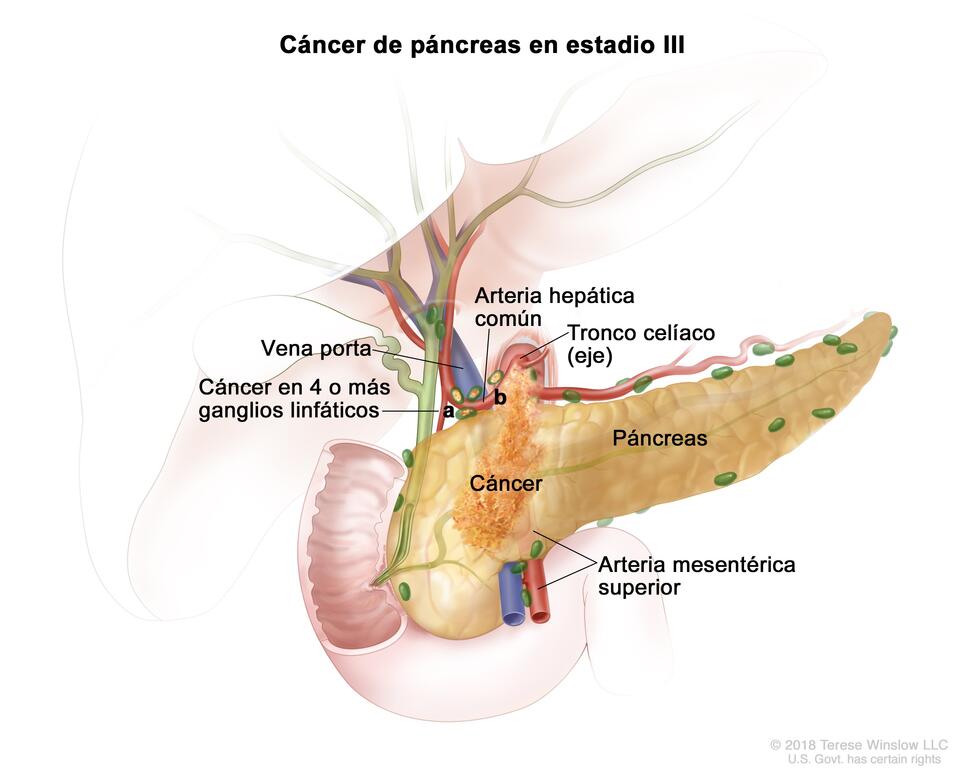 En la imagen, se observa cáncer en el páncreas y en a) 4 o más ganglios linfáticos cercanos y b) la arteria hepática común. También se observa la vena porta, el tronco celíaco (eje) y la arteria mesentérica superior.
