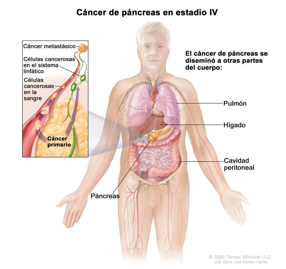 En el dibujo se observan otras partes del cuerpo adonde el cáncer de páncreas se puede diseminar, como el pulmón, el hígado y la cavidad peritoneal. En el recuadro se observan las células cancerosas que se diseminan desde el páncreas, a través de la sangre y el sistema linfático, a otra parte del cuerpo donde se formó el cáncer metastásico.