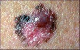 A close-up photo of melanoma on otherwise health skin. The area of the melanoma is black and mostly reddish-pink; a small mole-sized growth, purplish red, sit on top of the top right of the melanoma area.
