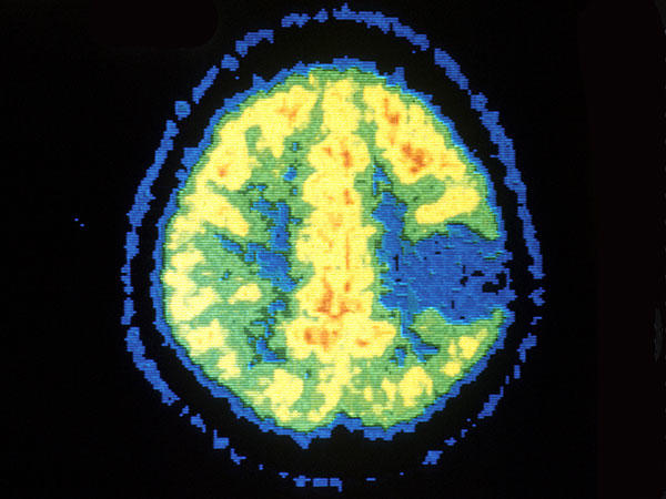 PET scan of brain showing astrocytoma