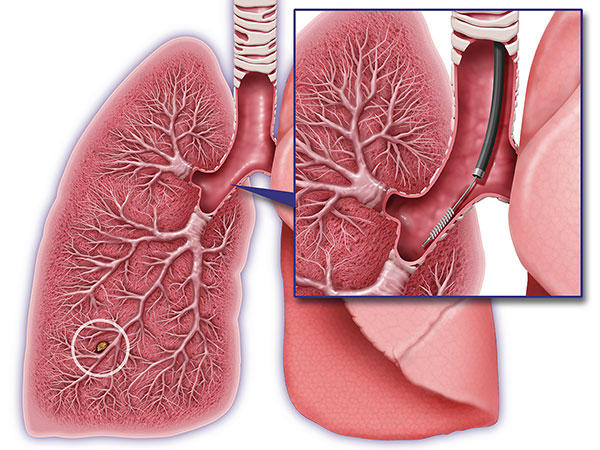 An illustration of a lung with inset. The lung has a circle in the lower left area, indicating this is where cancer could be. The inset shows a small brush inside of the upper airway.