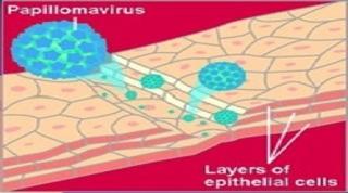 Medical illustration showing human papillomavirus (HPV) infecting cervical epithelial cells, with blue circular viral particles penetrating through layers of cervical tissue that could lead to abnormal cell changes and cervical cancer if infection persists.