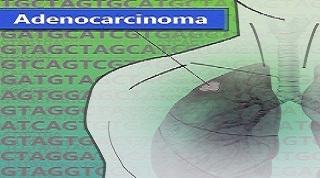 Diagram illustrating adenocarcinoma, showing a section of the human torso with a focus on the lungs, highlighting a small mass indicative of a tumor. The background contains repeating DNA sequences (A, T, C, G), symbolizing genetic aspects of cancer. The word "Adenocarcinoma" is prominently displayed at the top