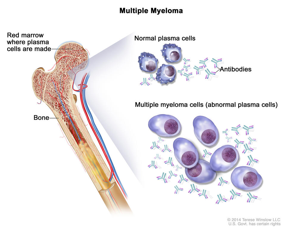 An illustration labeled “Multiple Myeloma” shows a cross section of a bone on the left. The top part of the bone, labeled “Red marrow where plasma cells are made”, links to two different groups of illustrations on the right. The top illustration labels normal plasma cells and antibodies, which have relatively equivalent amounts. The bottom illustration labels multiple myeloma cells (abnormal plasma cells), showing plasma cells that are larger and many more antibodies compared to the top illustration. 