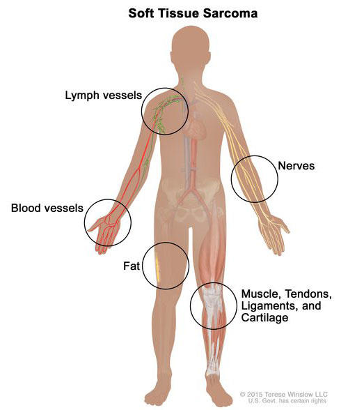 An illustration of the human body titled “Soft Tissue Sarcoma.” The body is in silhouette and has labels for various parts of the human body which are illustrated to mimic the look of each part. The labels read “Nerves”, “Muscle, Tendons, Ligaments and Cartilage”, “Fat”, “Blood Vessels”, and “Lymph Vessels.”