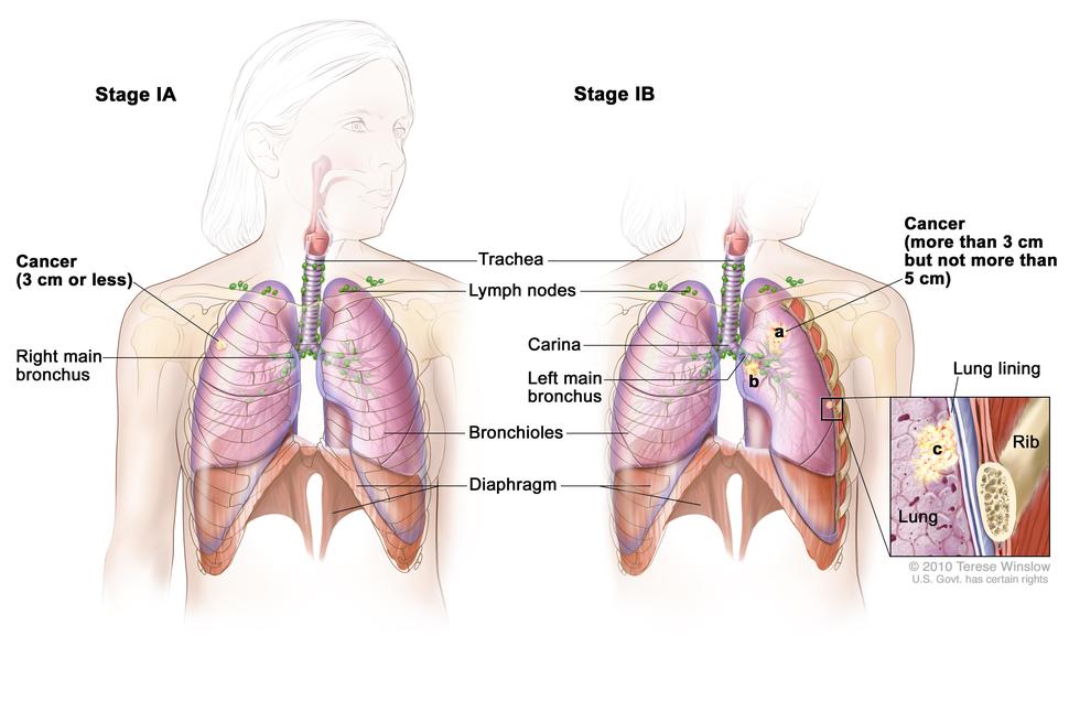 Illustration comparing Stage IA and Stage IB lung cancer. The left side shows Stage IA: A tumor 3 cm or less in the right lung, near the right main bronchus. Lymph nodes and anatomical features like the trachea, bronchioles, and diaphragm are labeled. The right side shows Stage IB: A tumor larger than 3 cm but not more than 5 cm in the left lung. Labels include the left main bronchus, carina, and more lymph nodes. An inset shows the lung lining, rib, and lung tissue, highlighting the tumor’s location.