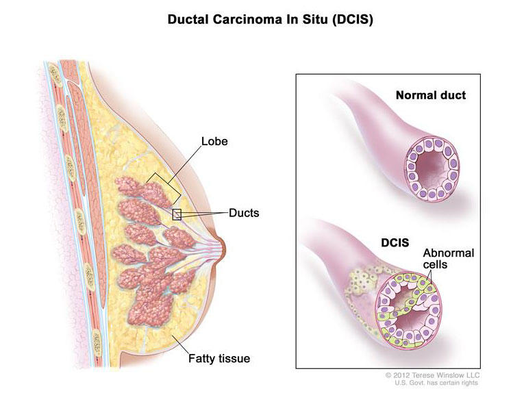 Illustration of Ductal Carcinoma In Situ (DCIS) in the breast. On the left, a cross-section of the breast shows the lobe, ducts, and fatty tissue. On the right, a close-up comparison of a normal duct and a duct affected by DCIS. The normal duct is shown with regular cells, while the DCIS duct shows abnormal cells inside.