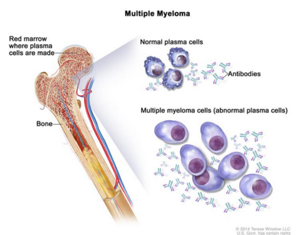 An illustration labeled “Multiple Myeloma” shows a cross section of a bone on the left. The top part of the bone, labeled “Red marrow where plasma cells are made”, links to two different groups of illustrations on the right. The top illustration labels normal plasma cells and antibodies, which have relatively equivalent amounts. The bottom illustration labels multiple myeloma cells (abnormal plasma cells), showing plasma cells that are larger and many more antibodies compared to the top illustration. 