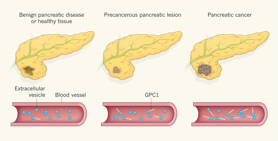 Three illustrations of the pancreas, ranging from benign diseases to precancerous lesion to pancreatic cancer. The cancer is shown as brown discoloration for the benign disease, growing to actual tumor cells on the right. Below each illustration, extracellular vesicles in the blood vessel gains more GPC1 as the pancreas gets more cancerous.