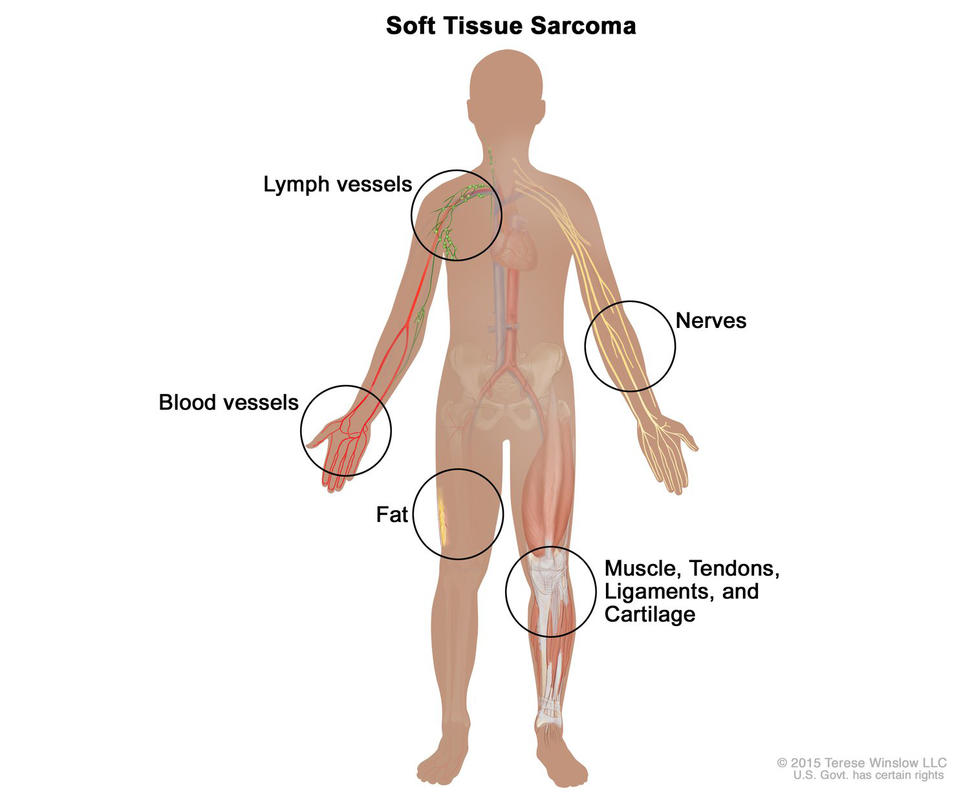 An illustration of the human body titled “Soft Tissue Sarcoma.” The body is in silhouette and has labels for various parts of the human body which are illustrated to mimic the look of each part. The labels read “Nerves”, “Muscle, Tendons, Ligaments and Cartilage”, “Fat”, “Blood Vessels”, and “Lymph Vessels.”