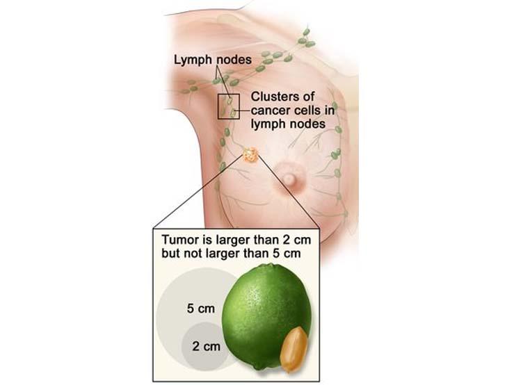 Illustration of breast cancer, labeling lymph nodes and clusters of cancer cells in lymph nodes. An inset coming from a tumor in the illustration reads: Tumor is larger than 2 cm but not larger than 5 cm. An inset compares the size to a lime and a peanut.