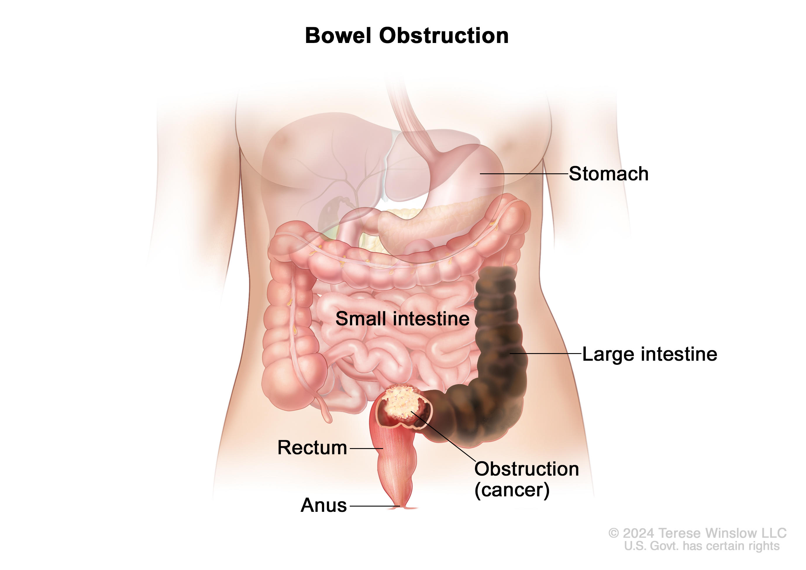 semaglutide intestinal blockage Bowel Obstruction and Cancer - Side Effects
