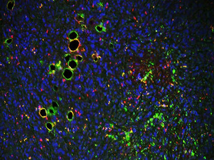 A microscopic view of breast cancer cells