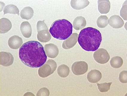 Microscope image of blood cells showing normal red blood cells alongside three larger, purple-stained white blood cells (lymphocytes).