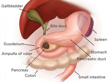 Illustration of a pancreatic tumor.
