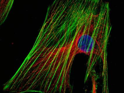 Metastatic cervical cancer cells