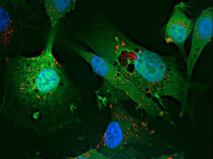 Microscopic image of glioblastoma cells in culture. Various shapes of green fading into black have small areas of light green and blue on top of them. Very small orange and red dots can also be seen.