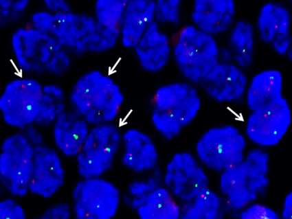 Microscopic view of Ewing sarcoma cells with arrows indicating gene fusions involving the EWS gene.